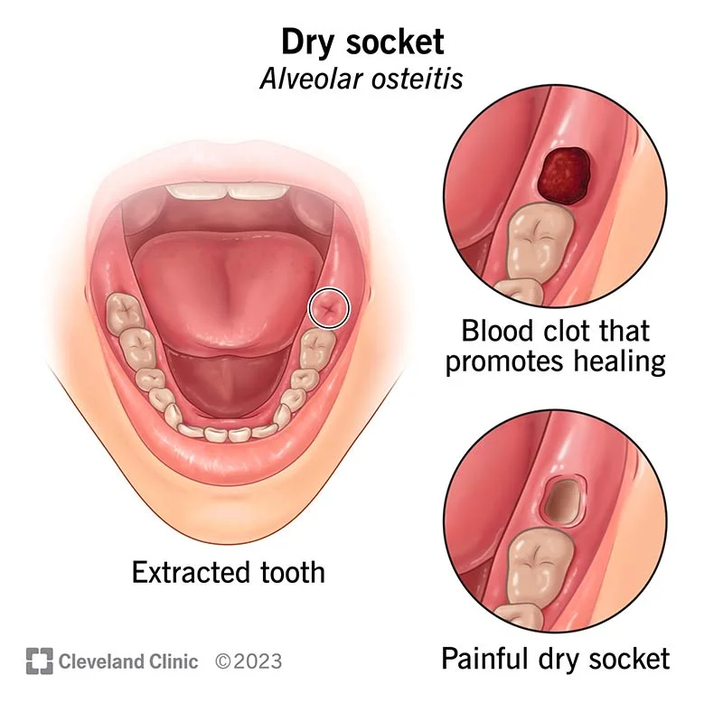 Dry Socket - Alveolar Osteitis at The Tooth Company Jubilee Hills