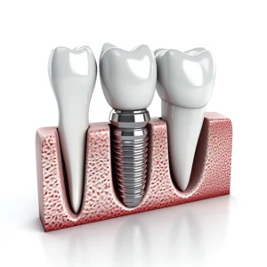 blog 1 Dentals implants at the tooth company