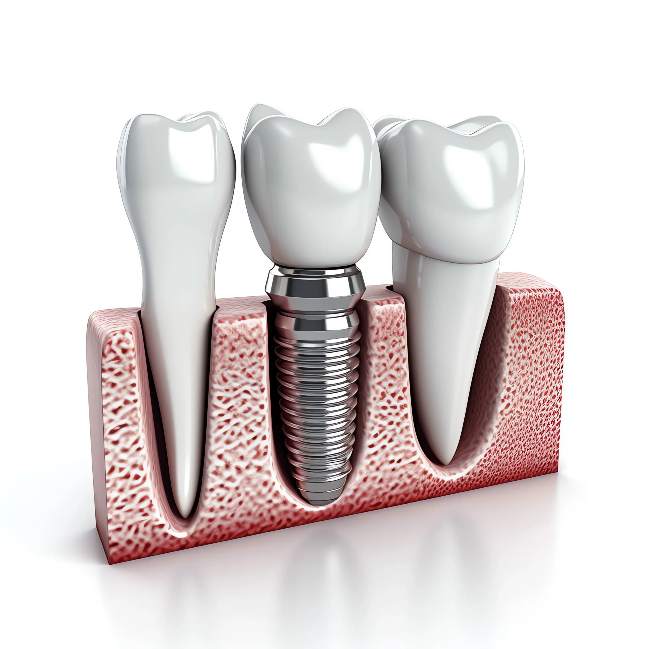Dentals implants at the tooth company scaled