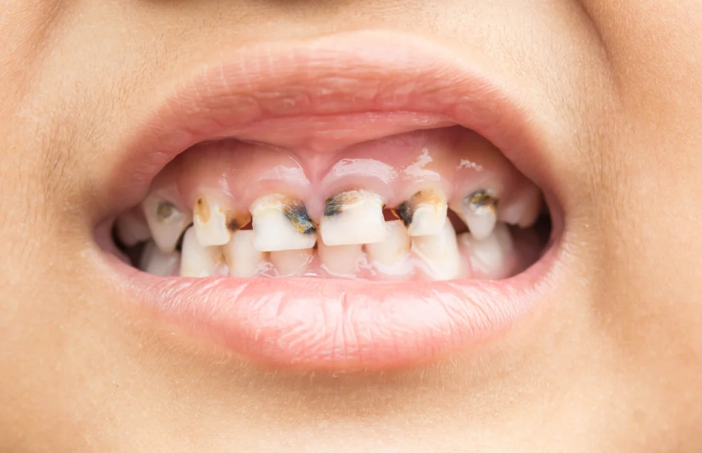 What Is a Cavity? How It Forms and How to Stop It Early 2 The 5 stages of tooth decay — from demineralisation to abscess