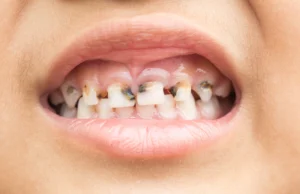 The 5 stages of tooth decay — from demineralisation to abscess
