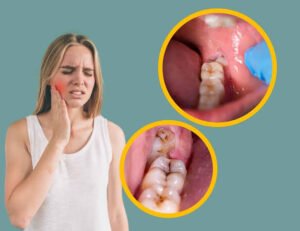 Wisdom tooth pain — normal eruption vs impaction explained